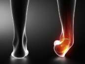 Entorse de tornozelo